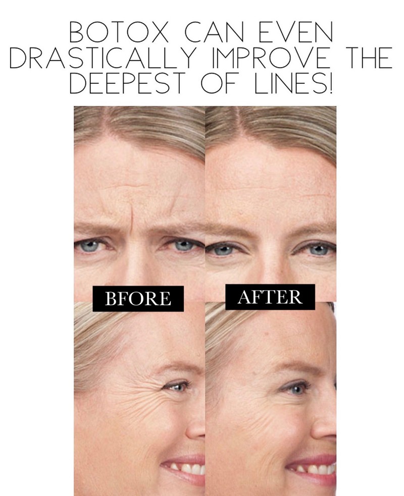 Botox Before and After Treatment