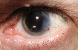 symptoms of cataracts