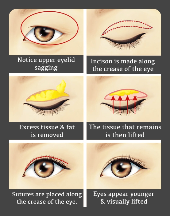 Blepharoplasty Fact Sheet