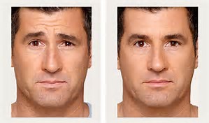 Botox Treatments