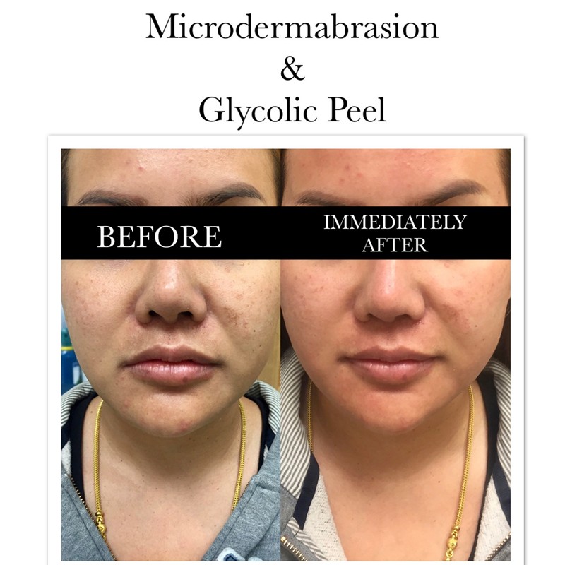 Microdermabrasion Before and After Treatment