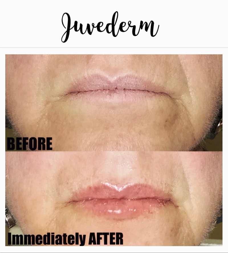 Juvederm Before and After Treatment
