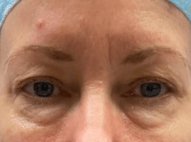 Lower Blepharoplasty