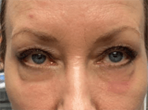 Upper Eyelid Plasma IQ